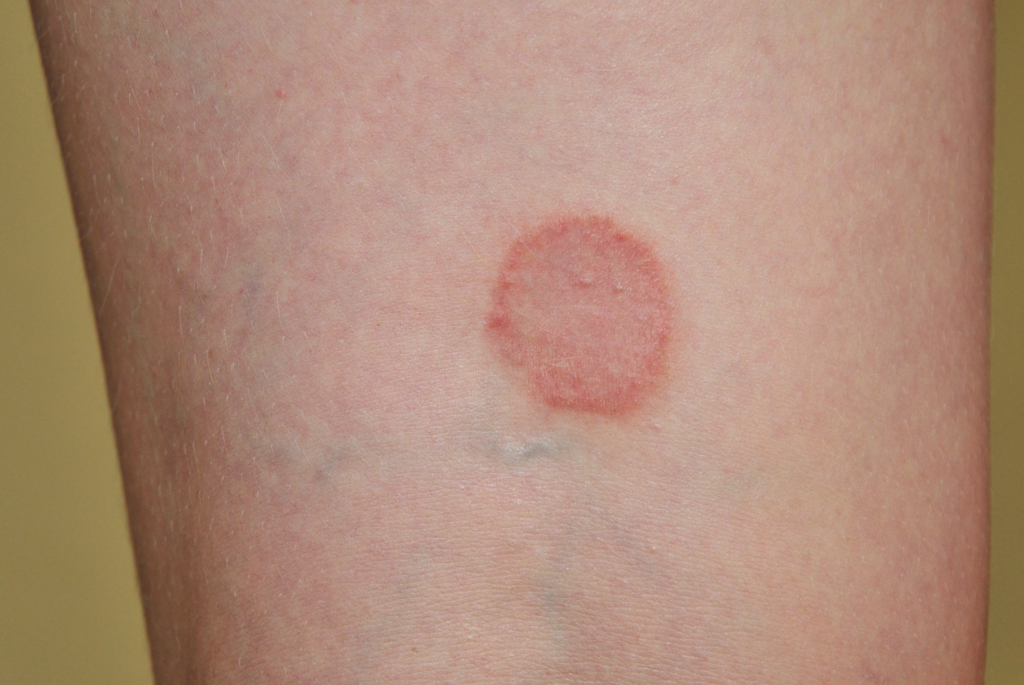 Lichen planus